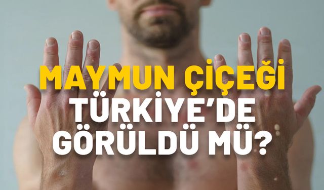 MAYMUN ÇİÇEĞİ ANKARA'DA GÖRÜLDÜ MÜ? SON DAKİKA AÇIKLAMASI! Maymun çiçeği nasıl bulaşıyor?